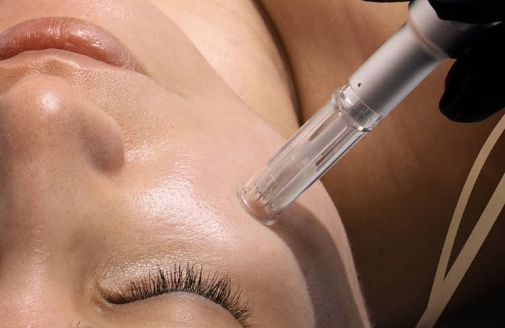 Tractament amb Dermapen