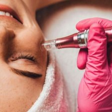 Dermapen Treatment