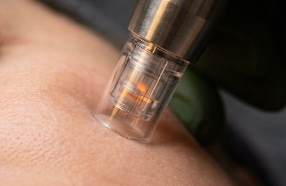 Dermapen Treatment