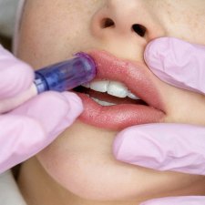 Hydralips Dermapen